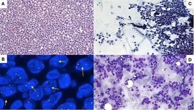 Performance of MYC, BCL2, and BCL6 break-apart FISH in small biopsies with large B-cell lymphoma: a retrospective Cytopathology Hematopathology Interinstitutional Consortium study